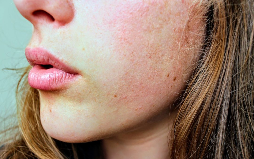 Rutina para cuidar la piel grasa o con acné de forma natural | Blog Adonia Cosmética
