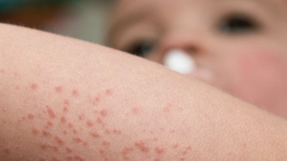 Dermatitis consejos para sanarla con tratamientos | Blog Adonia natural